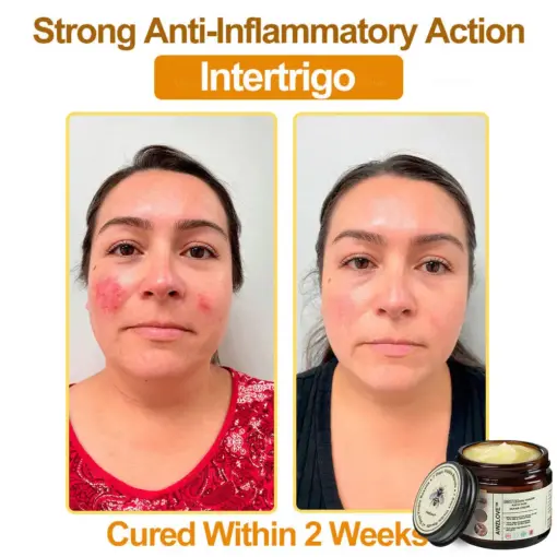 Awzlove™ Botox Bee Venom Rapid Skin Repair Cream