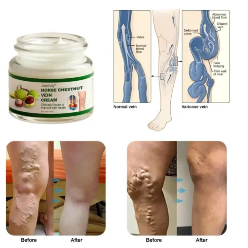 JORONDY® Horse Chestnut Vein Cream