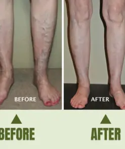 Timilk® Varicose Veins Healing Cream