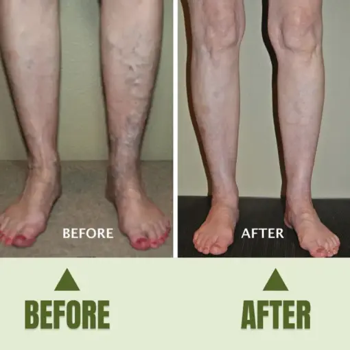 Timilk® Varicose Veins Healing Cream