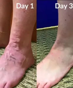 Timilk® Varicose Veins Healing Cream