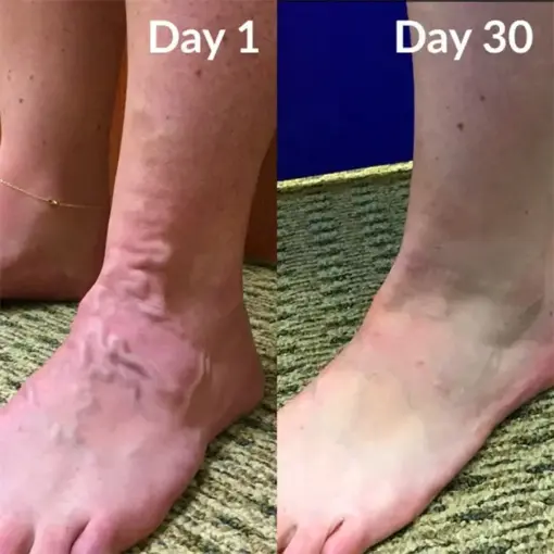 Timilk® Varicose Veins Healing Cream