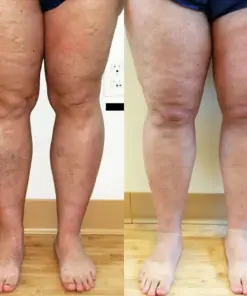 Timilk® Varicose Veins Healing Cream