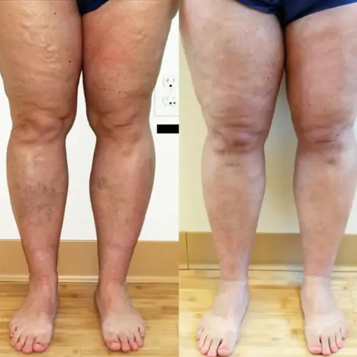Timilk® Varicose Veins Healing Cream