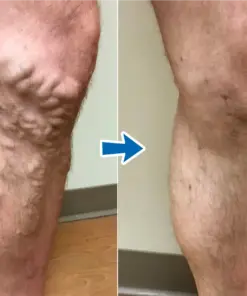 Timilk® VenoAid Varicose Solution Spray