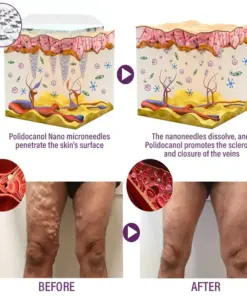 Timilk® Polidocanol Nano Varicose Vein Patch