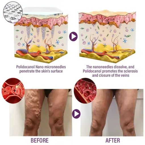 Timilk® Polidocanol Nano Varicose Vein Patch