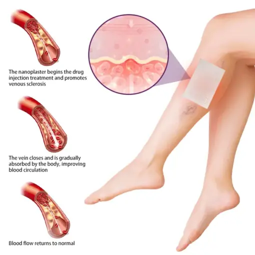 Timilk® Polidocanol Nano Varicose Vein Patch
