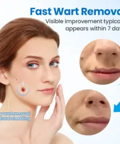 Timilk® TagGone Wart Removal Cream