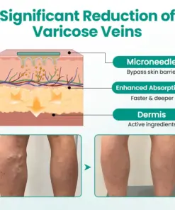 Timilk® LegRenew Varicose Veins Patch1