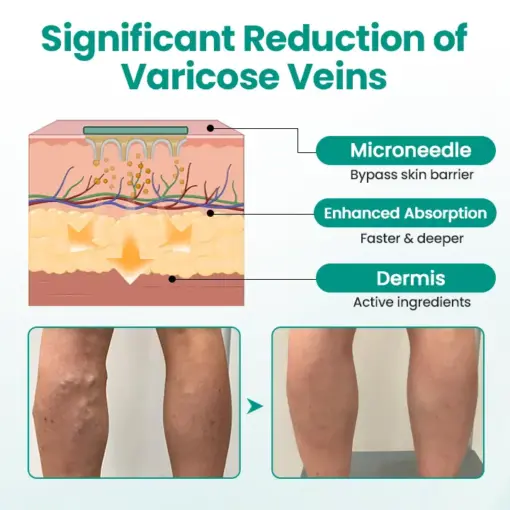 Timilk® LegRenew Varicose Veins Patch1