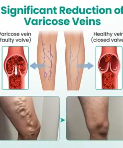 Timilk® LegRenew Varicose Veins Patch1