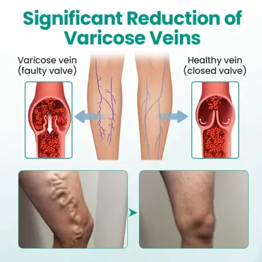 Timilk® LegRenew Varicose Veins Patch1