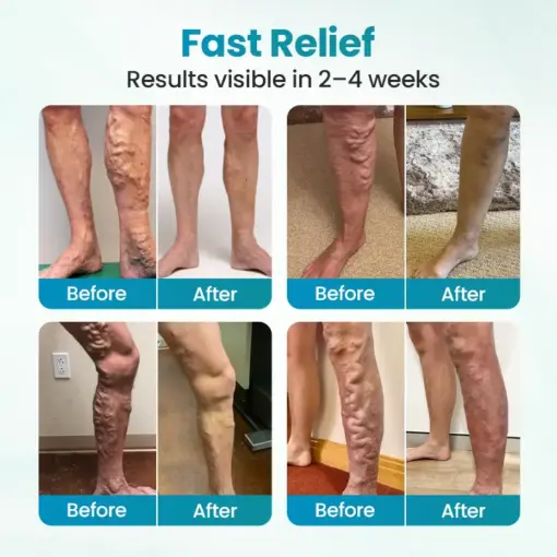 Timilk® VeinAway Relief Cream