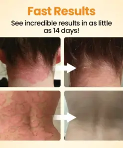 Timilk®BeeLieve Psoriasis Skin Care