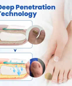 Timilk® FungalPatch - Antibacterial Fungal Patch