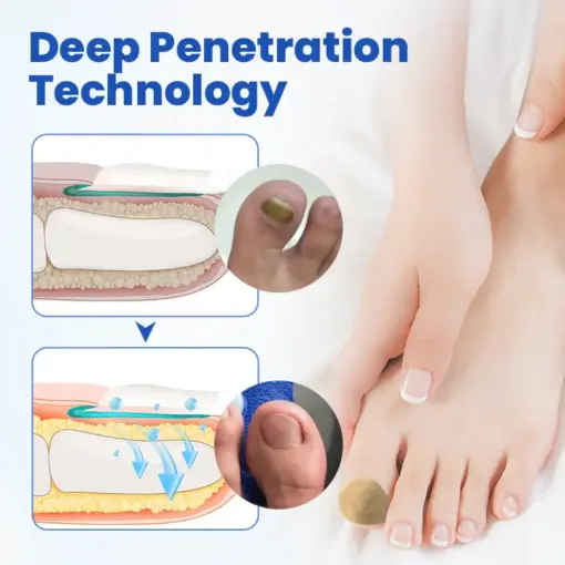 Timilk® FungalPatch - Antibacterial Fungal Patch