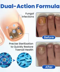 Timilk® FungalPatch - Antibacterial Fungal Patch