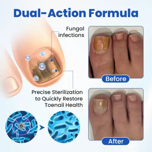 Timilk® FungalPatch - Antibacterial Fungal Patch