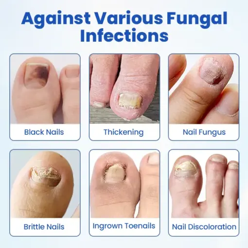 Timilk® FungalPatch - Antibacterial Fungal Patch