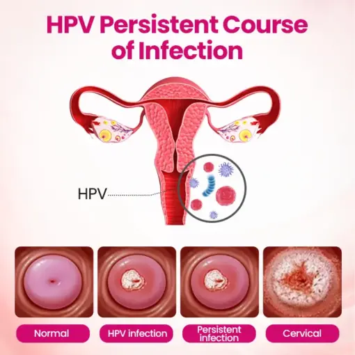 Timilk® IntiDefend Anti-HPV Interferon Gel