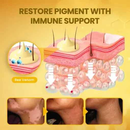 Timilk® NaturaViti Bee Venom Vitiligo Cream
