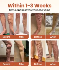 Timilk® VeinTarget Microneedle Patch