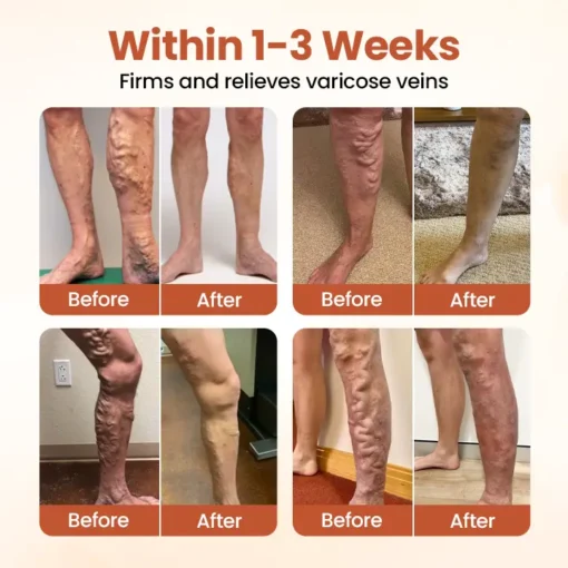 Timilk® VeinTarget Microneedle Patch