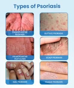 Timilk® MagnesiumHerb Psoriasis Relief Cream
