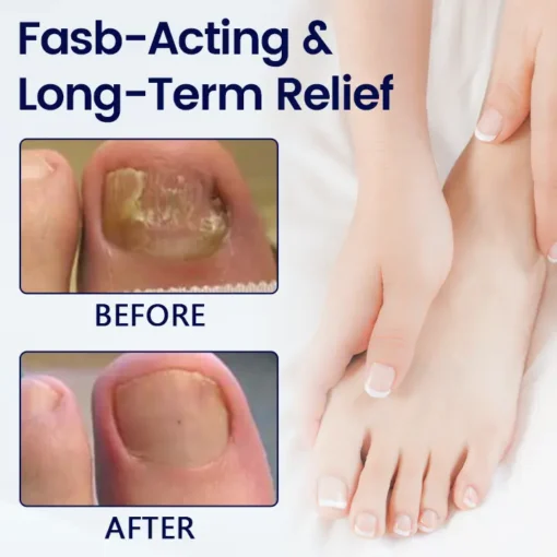 Timilk® Anti-Fungal Nail Repair Patch