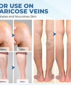 Timilk® TheraVein Varicose Herbal Spray