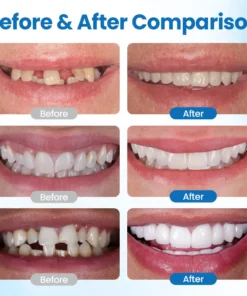 Timilk® SmileMend Tooth Repair Filling Kit