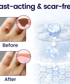 Timilk® WartErase Cryo Freeze Spray