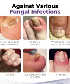 Timilk® MycoOut Natural Nail Fungus Solution