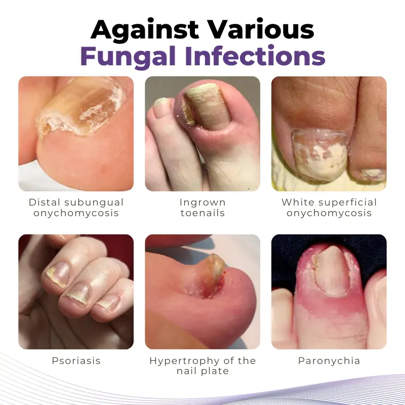 Timilk® MycoOut Natural Nail Fungus Solution