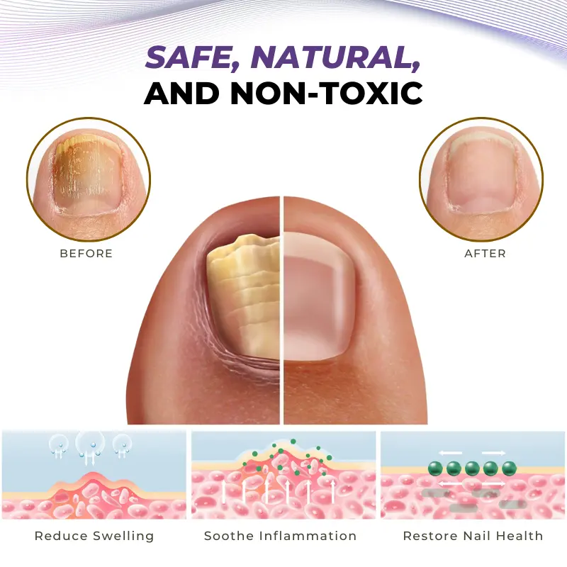 Timilk® MycoOut Natural Nail Fungus Solution