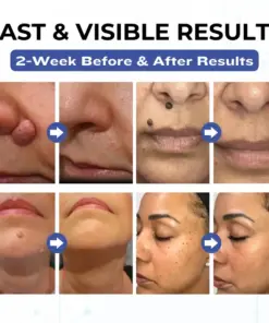 Timilk® VanishPro Skin Spot Removal Cream