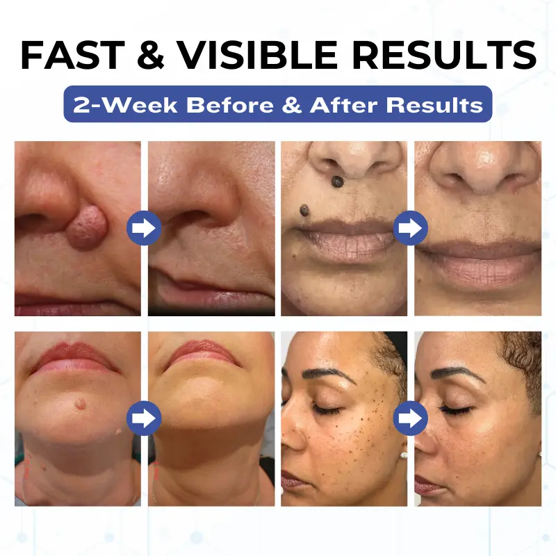 Timilk® VanishPro Skin Spot Removal Cream