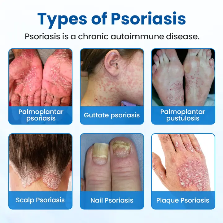 Timilk® PsoriaHeal Herbal Magnesium Soothing Spray - Image 3