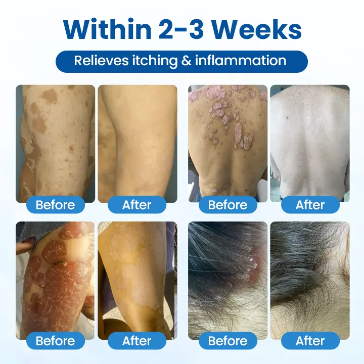 Timilk® PsoriaHeal Herbal Magnesium Soothing Spray - Image 4