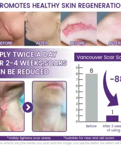 Timilk® ReGenScar Stem Cell Scar Gel