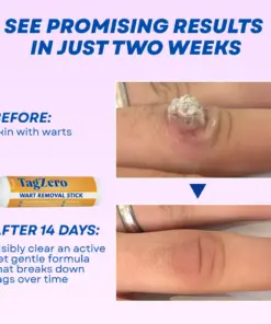 Timilk® TagZero Wart Removal Stick