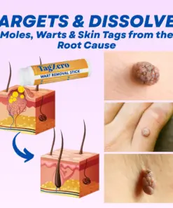 Timilk® TagZero Wart Removal Stick