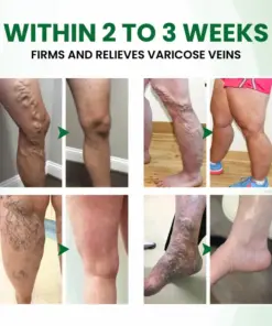 Timilk® VariPoint™ Phyto-Vascular Microneedle Patch