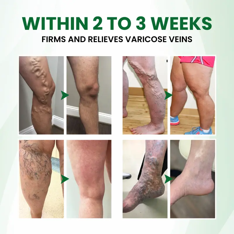 Timilk® VariPoint™ Phyto-Vascular Microneedle Patch