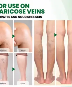 Timilk® VariPoint™ Phyto-Vascular Microneedle Patch