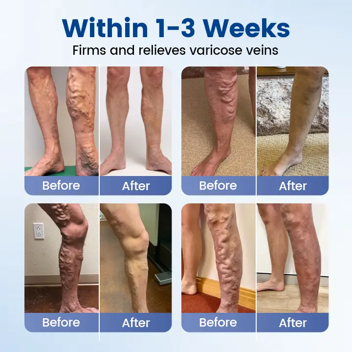 Timilk® Vein Ease Microneedle Therapy Patch – Fast Effective and Non-Invasive Treatment for Varicose Veins Leg Swelling