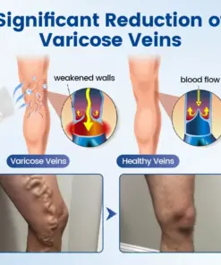 Timilk® Vein Ease Microneedle Therapy Patch – Fast Effective and Non-Invasive Treatment for Varicose Veins Leg Swelling