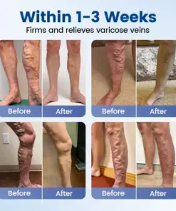 Timilk® Vein Ease Microneedle Therapy Patch - Fast ⚡Effective 💪 and Non-Invasive 🚫 Treatment for Varicose Veins & Leg Swelling 👣