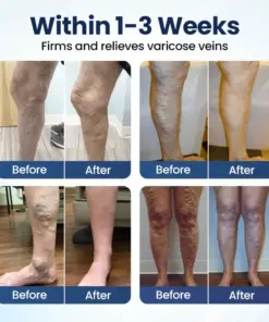 Timilk® Deep Vein Repair Microneedle Patch